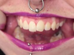 Crooked Teeth Porn